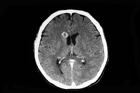 对脑出血的病人进行CT扫描图片