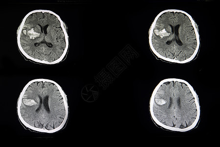 对急性出血性中风的病人进行CT扫描治疗情况解剖学中风疾病射线颅骨手术神经诊断图片