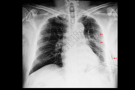 对肋骨骨折和胸膜骨折的病人进行胸部X光检查图片