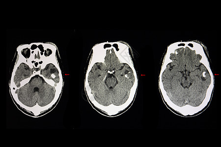 细胞脑肿瘤图片