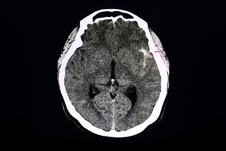 CT 大脑骨折动脉瘤图片