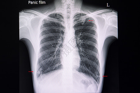 a 胸部X射线 肺部多处点心渗透图片