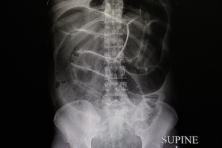肠道阻塞身体医学病人医院x射线外科x光诊断扫描大肠图片
