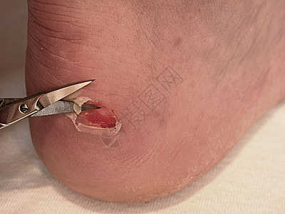 小刀子在裂开的水泡上割伤人的脚跟 被撕破皮肤而痛苦的地方图片