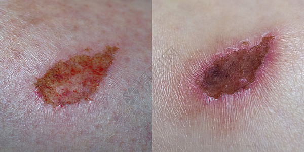 伤疤组织真皮卫生瘢痕疤痕药品感染医疗手臂皮肤伤口图片