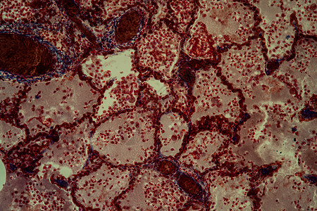 200x 显微镜下的肺组织肺结核组织疾病块茎科学病菌筷子腐烂组织学红色病理学结节图片