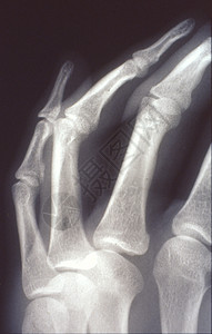 X光图像 男人 手与骨头和关节事故组织诊断医院科学休息考试指骨药品医生背景图片