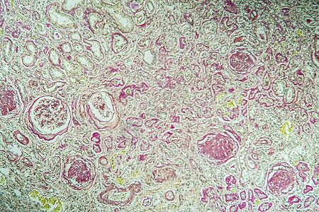 显微镜下的肾脏病组织萎缩 100x细胞组织学肾炎诊断疾病肾小球药品肾脏病理考试图片
