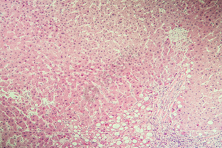 100x 显微镜下的肝硬化发病组织病理药品科学宏观诊断组织学癌症疾病考试图片