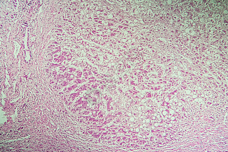 100x 显微镜下的肝硬化发病组织宏观组织学病理中毒诊断考试科学药品毒理学疾病图片
