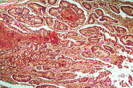 第1节 肿瘤组织组织部分 1 含有葡萄和淋巴细胞的睾丸素放大镜生物学宏观绒毛薄片科学诊断癌症药品疾病背景