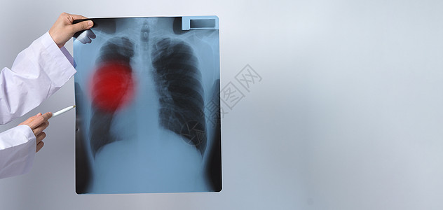 亚洲女医生持有和检查肺部X光片扫描诊断关心x射线疾病x光药品肺炎胸部射线图片