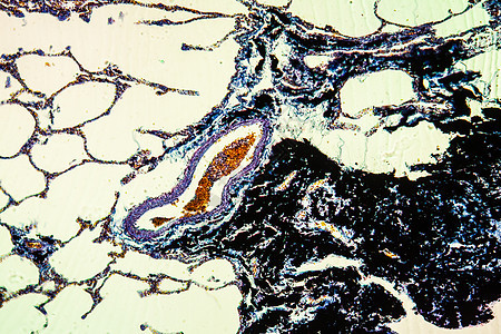 炭粉肺病组织 100x义务药品煤尘肺科学协会宏观黑色组织学报告尘肺背景图片