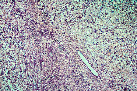 100x 子宫疾病组织细胞瘤薄片组织学细胞生长红色放大镜子宫疾病女性科学图片