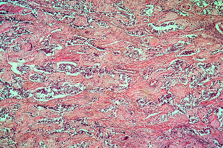 甲状腺疾病组织100x的混合肿瘤细胞癌症组织学薄片放大镜病理腺体科学宏观增殖图片