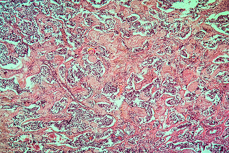 甲状腺疾病组织100x的混合肿瘤组织学放大镜增殖薄片宏观腺体药品病理科学腐烂图片