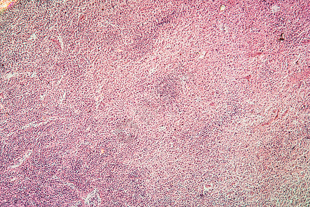 淋巴腺癌 疾病组织 100x淋巴腺腺体癌症宏观淋巴瘤科学薄片增殖药品细胞图片
