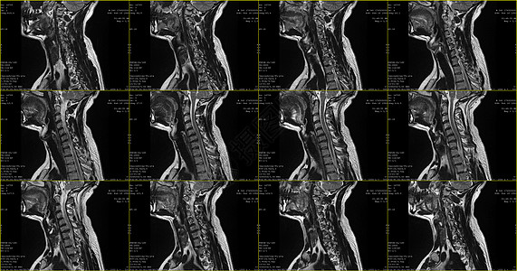 在C6-C7片段用放射细胞病进行双边半中间体外延伸的34岁大白鲸男性颈部区域 对C6-C7片段进行一组成像性核磁RI扫描图片