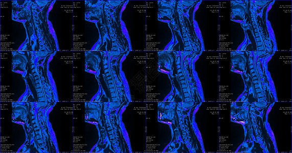 宝马X7一套12个剖面蓝色彩色MRI扫描仪 对C6-C7片段双边半中间体延伸的34岁大白鲸男性颈部区域进行检查背景