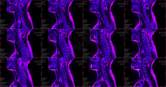 一套6个剖面绿色彩色MRI扫描仪 对C6C7片段双边半中间体延伸的34岁大白鲸男性颈部区域进行检查电脑解剖学痛苦脊柱技术x光成人图片
