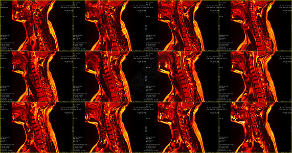 宝马X7一套12个外观红红色MRI扫描仪 对C6-C7片段双边半中间体延伸的34岁大白鲸男性颈部区域进行检查背景