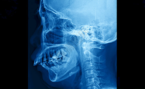 胶片X光头骨和宫颈脊椎横向视图 从鼻子到胸部的人体骨骼X光膜手臂身体放射科临床扫描科学颅骨疼痛病人x光图片
