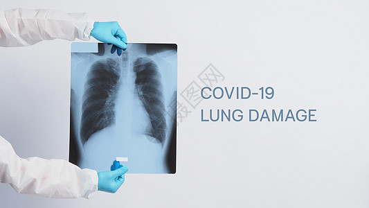 Covid 19肺损伤的X光薄片和医生手用医疗手套和个人防护设备托持感染x光病人诊所放射科医院肺炎癌症射线科学图片