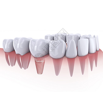 植入和植入牙齿插图凹痕白色矫正牙医骨科医生口腔科搪瓷技术图片