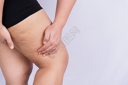 女性握住并推动腿部橘皮组织或橘皮的皮肤 治疗和处理超重皮下脂肪组织沉积屁股内衣肥胖脂肪橙子分数饮食重量按摩数字背景图片