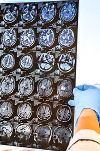 医生在医务室保护戴脑部核磁共振的手套 对诊所的人头进行核磁共振扫描测试职业癌症谐振防护药品解剖学生理扫描器断层图片