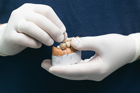 种植牙上的假肢 骨科牙科的概念 种植体上的陶瓷桥 牙医的手拿着一个带牙基牙的石膏下颌 石膏模型上植入的陶瓷牙图片