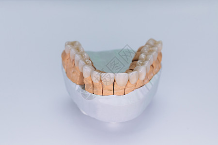 锆冠贴面 在白色背景上隔离的石膏模型上贴有贴面的陶瓷牙齿 石膏模型陶瓷桥图片