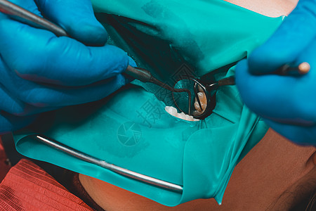 后牙治疗 橡胶大坝覆盖的口腔治疗 现代技术不育治疗等服务乐器内阁橡皮障医生喷射牙科钻孔夹钳手套疾病图片