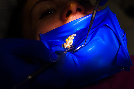 移动考勤在橡胶大坝 橡胶大坝和牙科镜的隔绝物上用白色合成树脂填牙后 将病人的嘴缝合牙科卫生尖端框架器械办公室乳胶牙医微笑围堰背景