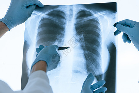 医疗同事在讨论肺部X光片的问题 笑声支气管实验室医生照相射线并发症病人诊所哮喘胸部图片