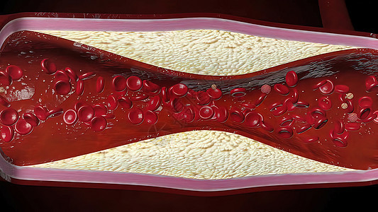 由胆固醇血液或容器内引发冠心动动脉病的板块导致的胆固醇血或红细胞流动梗阻动脉硬化牌匾形成镜头毛细管主动脉心脏病学图片