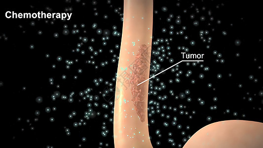 化疗应用在肿瘤地区 肿瘤被清理干净了病人微生物学保健前列腺卫生预防组织癌症药品细胞图片