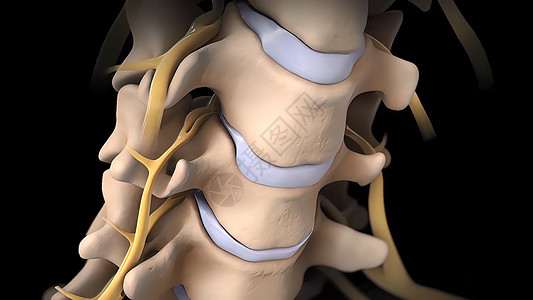 间脊椎盘片可能会变形 压缩神经的神经疼痛骨科骨骼手术柱子姿势疗法叶片药品诊断图片