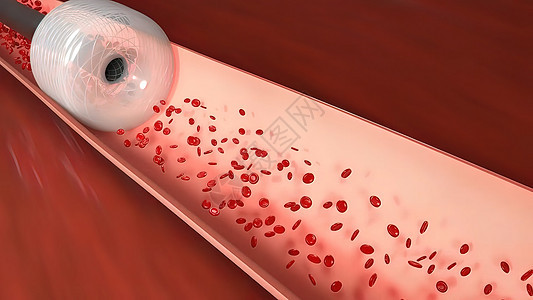 血管隔绝是阻塞血液容器 通常带有凝块动脉硬化微生物学横截面分子红细胞药品原生质流量动脉粥样硬化血流图片