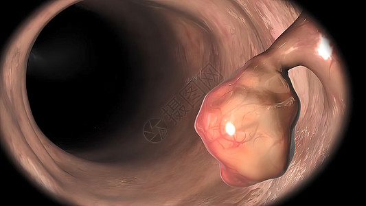 肿瘤细胞用钩子切出诊所息肉消化系统胃镜预防癌症辐射治疗医师手术背景图片