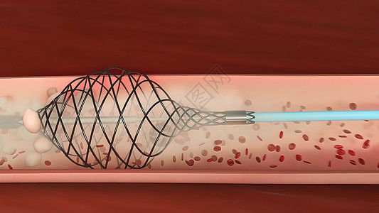 血管隔绝是阻塞血液容器 通常带有凝块动脉细胞疾病生物氧气食物心脏病学分子微生物学循环图片