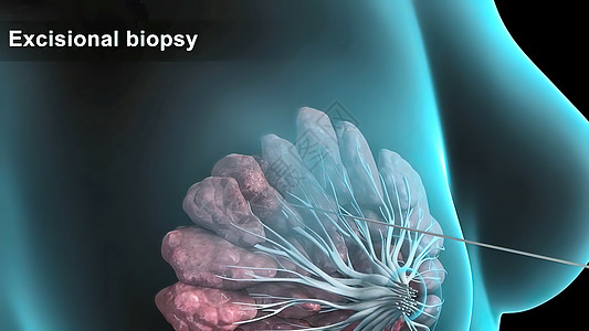 具有乳腺病理学的  女孩  女性人的结构说明和缝合淋巴瘤解剖学生物学辐射冒号细胞宏观身体技术硬化图片