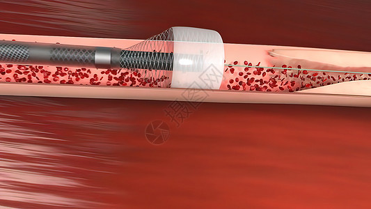 血管隔绝是阻塞血液容器 通常带有凝块细胞动脉粥样硬化动脉硬化系统食物化学运动心脏病学生物疾病图片
