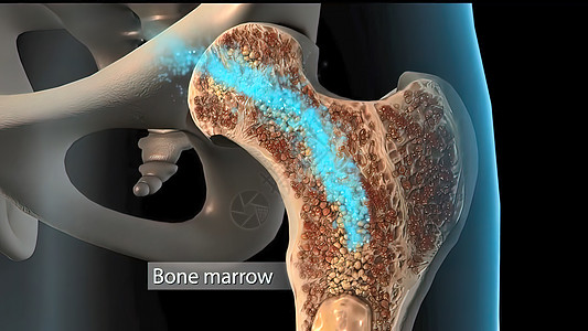 将人体骨质骨质疏松症海绵组织从正常组织发展成病人组织纤维吸收保健细胞科学解剖学卫生插图僵化休息图片