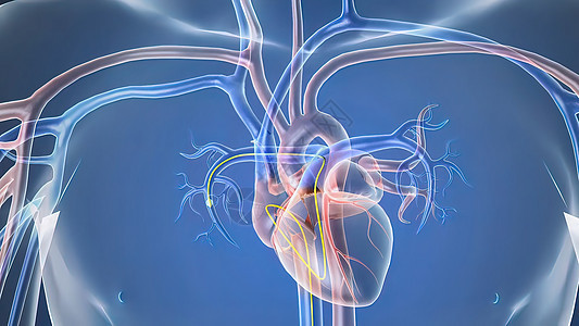 插入一个支节打开隐蔽的动脉心绞痛诊断卫生医生心肌支架手术医院外科细胞图片