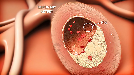 这表明(HDL)胆固醇水平在确定冠状动脉疾病风险方面很重要的图片