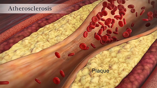 装有小板和胆固醇标志板 肥胖对健康风险概念的排布大动脉保健心血管粒子牌匾封锁红细胞疾病卫生动脉粥样硬化身体背景图片