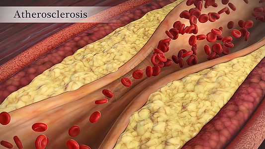 装有小板和胆固醇标志板 肥胖对健康风险概念的排布大动脉动脉粥样硬化血流医学粒子攻击疾病人体血管食物身体背景图片