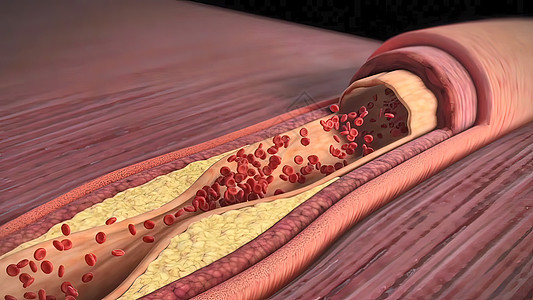 胆固醇斑块 神乐硬化和心脏病发作男人身体动脉粥样硬化视频科学动脉设计静脉主动脉流量图片