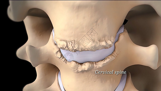 3D 黑色背景的宫颈脊椎3D医学插图整脊髓质骨科椎骨药品疼痛柱子手术骨干椎间图片